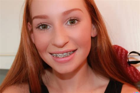 Pin By John Beeson On Girls In Braces Braces Girls Orthodontics Braces