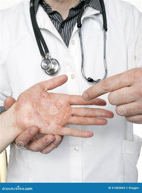 dermatoloog die hand met streng eczema onderzoeken stock afbeelding image  diagnostiseer