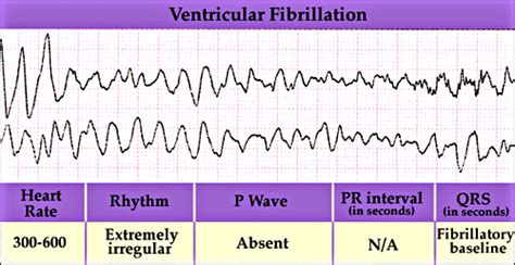 what is the major difference between ventricular flutter and