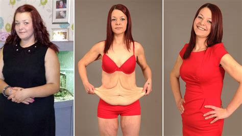 Extreme Weight Loss Excess Skin Weightlosslook