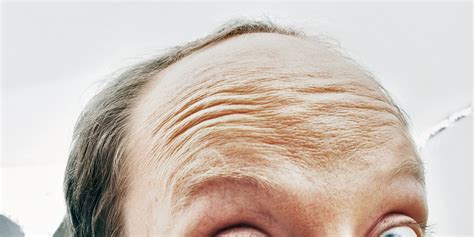 Early Balding And Gray Hair Linked To Heart Disease Men’s Health