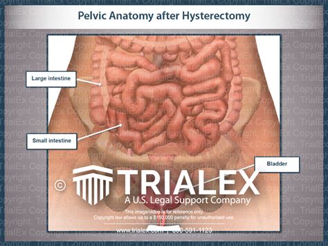 Pelvic Anatomy After Hysterectomy Trialexhibits Inc