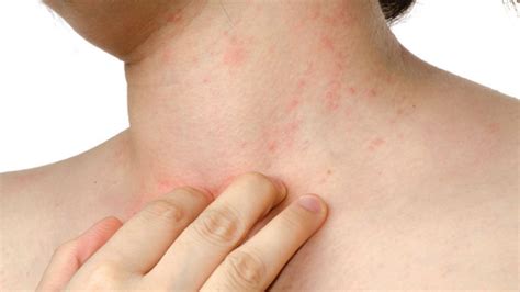 el aumento de casos de alergias de piel infofueguina