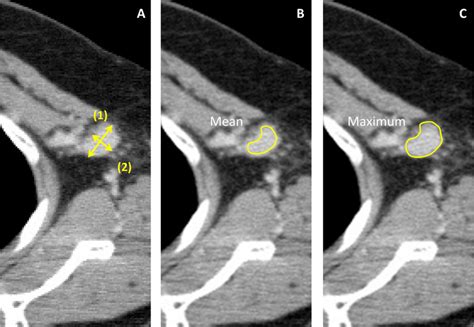 Measurement Of Axillary Lymph Nodes In A Patient With