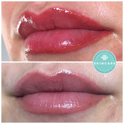 lip tattooing skincare laser clinic
