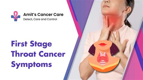 first stage throat cancer symptoms diagnosis and treatment