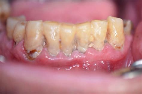 oral health     valuable   lose  teeth    types