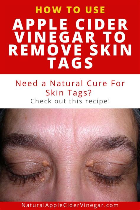 how to use apple cider vinegar to remove skin tags skin tag removal