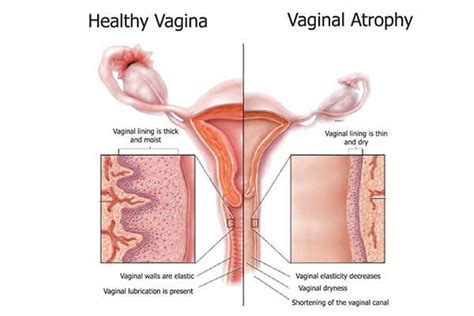 dry vaginal skin detailed knowledge about the treatment