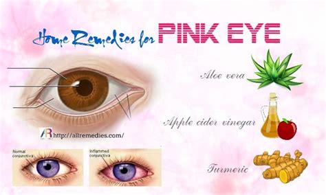 home remedies  pink eye  adults