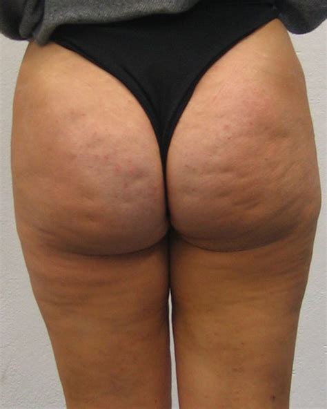 ass dimples cellulite cumception
