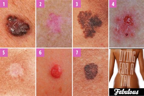 Spot On Can You Spot Which Moles Are Deadly The Skin