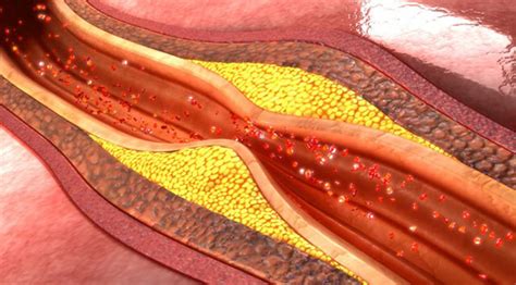 Arterioesclerosis Causas Síntomas Y Tratamiento