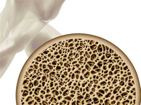 morselized bone compared  intact bone aspire medical innovation