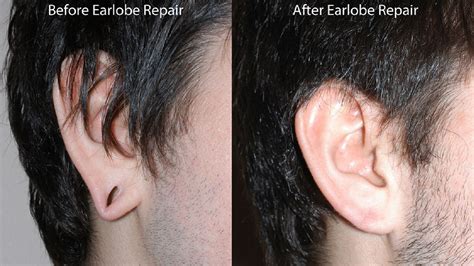 20 minute procedure can repair ripped earlobes abc13 houston