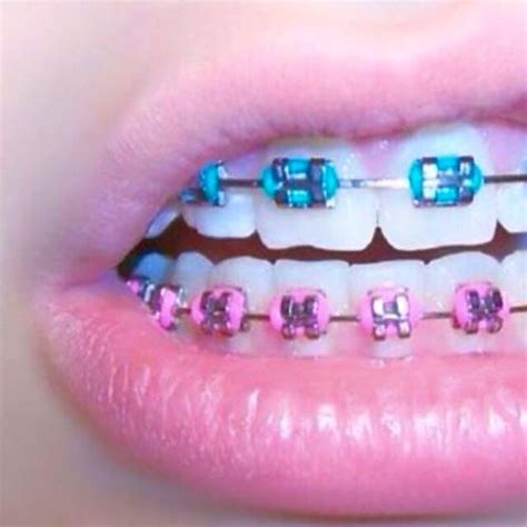 braces teeth colors pink braces cute braces colors teeth braces