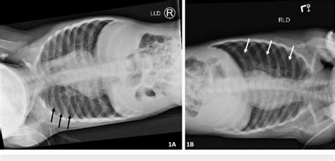 A Left Lateral Decubitus X Ray On Day Four Demonstrated