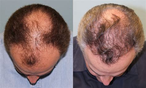 Hair Transplant Before And After 4 Jesse E Smith Md Facs Ft Worth
