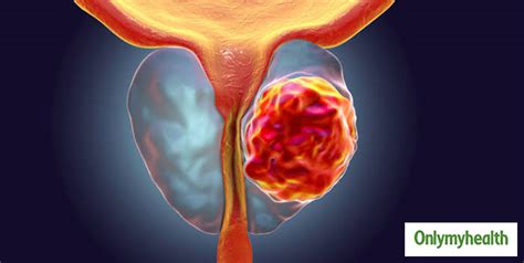 prostate cancer symptoms causes stages diagnosis and treatment