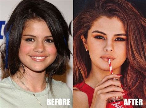 Selena Gomez Plastic Surgery Before And After Photos