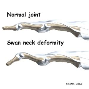 rheumatoid arthritis swan neck deformity  finger symptoms treatment
