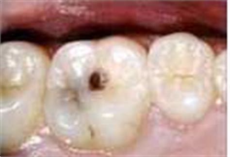 cavity basics cavities  fillings  howstuffworks
