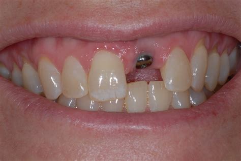 dental implants dublin teeth replacements dublin implant crowns dublin