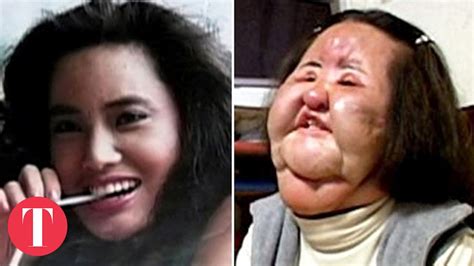 10 Cases Of Plastic Surgery Gone Terribly Wrong Beauty