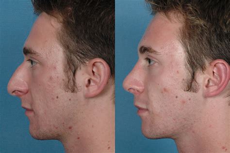 surgical rhinoplasty il injectable rhinoplasty champaign