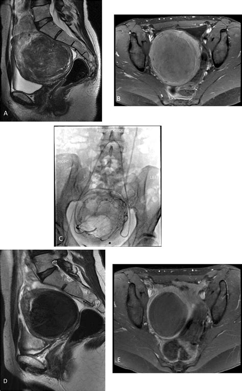 forty year old female patient a sagittal t2 weighted mr image shows a