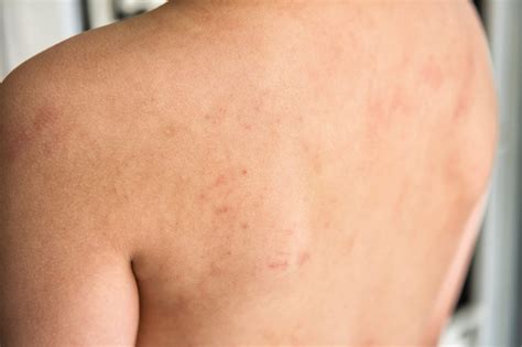 connection  food allergies  eczema nabta health