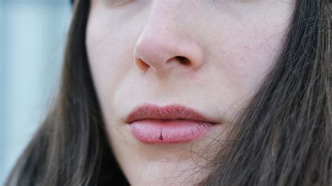 rid  lip pimples swollen big painful upper    lips american celiac