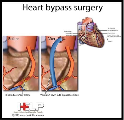 heart bypass surgery hypochondria bypass surgery medical information