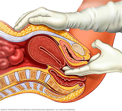 Uterine Fibroids Disease Reference Guide