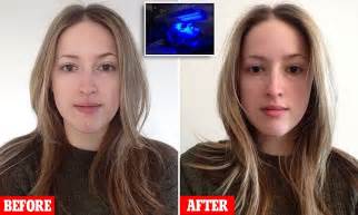 led treatment using skin penetrating wavelengths of light promises to rid you of breakouts for