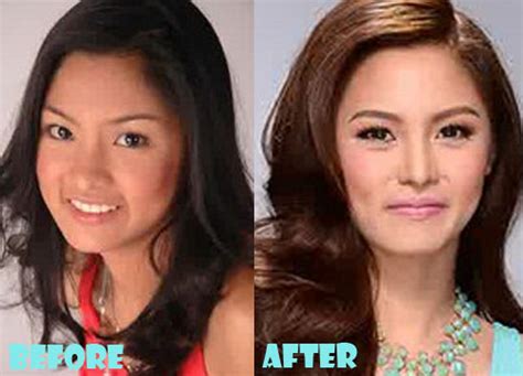 Kim Chiu Plastic Surgery Before And After Nose Job Breast