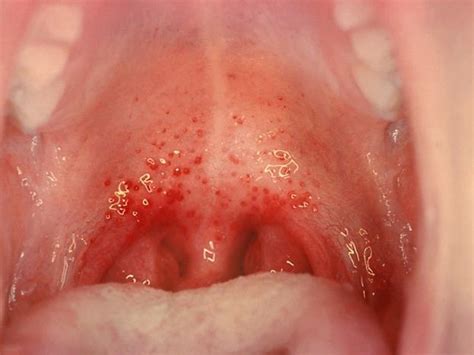 Recurring Strep Throat Causes And Treatments New Health Advisor