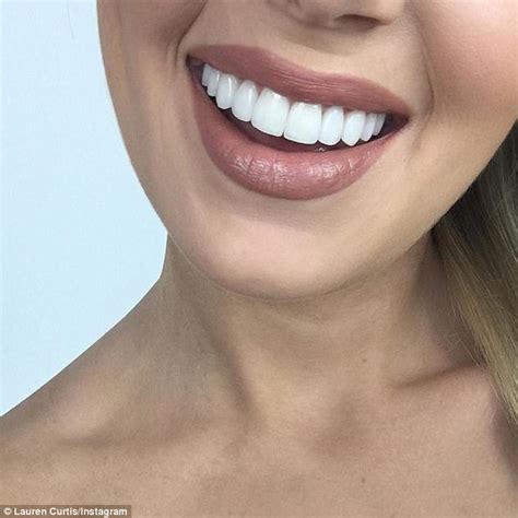 australian dentist on the truth about dental veneers