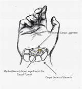 Carpal Tunnel Labels Symptoms sketch template