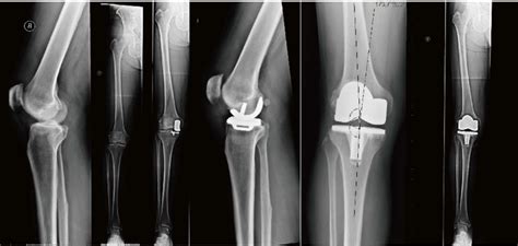 unicondylar knee replacement  revision arthroplasty