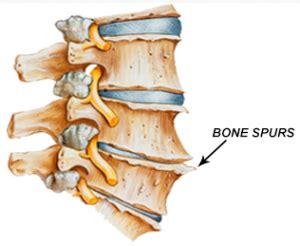 cervical bone spurs cervical osteophytes neck pain