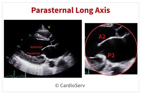 Finally Mitral Valve Orientation Explained Cardioserv