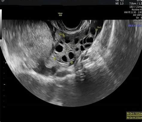 ultrasound diagnosis  ovarian torsion   efsumb