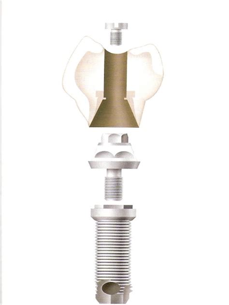 sevadharma dental clinic dental implant parts  implant