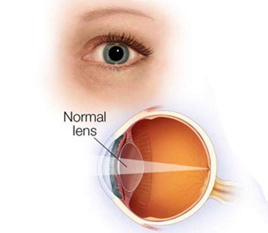 delaware eye clinic normal eye