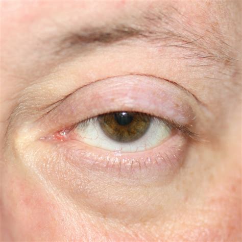 ptosis droopy eyelid  treatment milan eye center