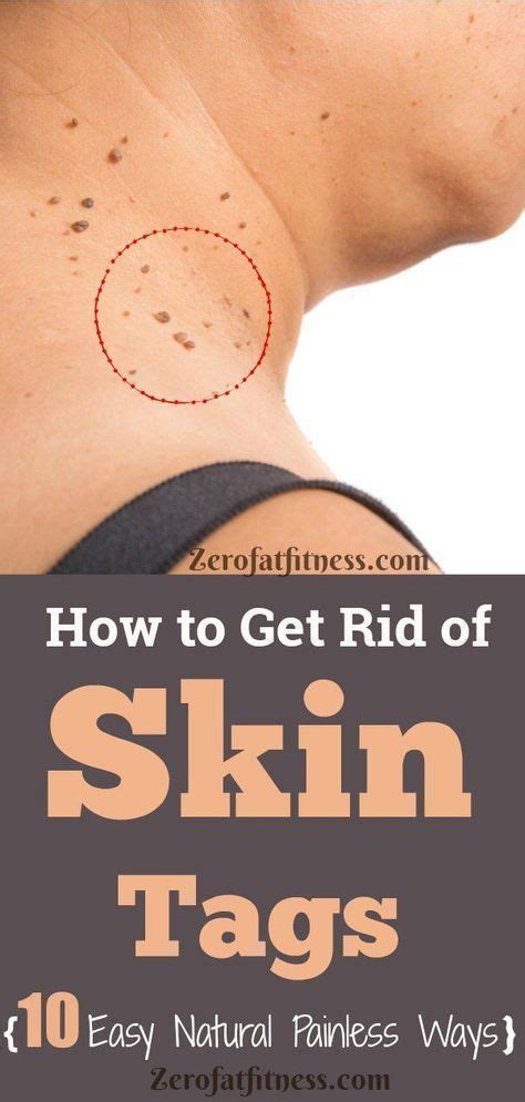 home remedies for skin tag removal skin tag removal home remedies for skin skin tag