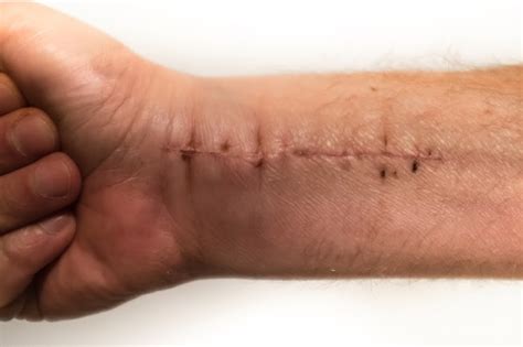 ways  prepare  wrist surgery recovery