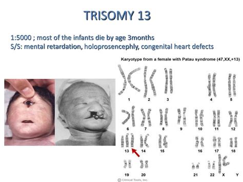 Ppt Chromosomal Abnormalities Powerpoint Presentation Free Download