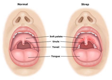 what does strep throat look like what does it look like find out